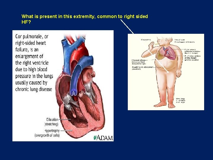 What is present in this extremity, common to right sided HF? 