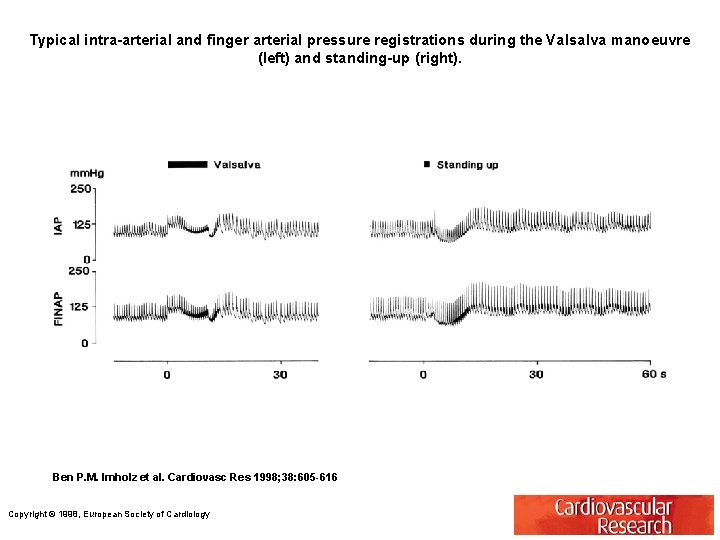 Typical intra-arterial and finger arterial pressure registrations during the Valsalva manoeuvre (left) and standing-up