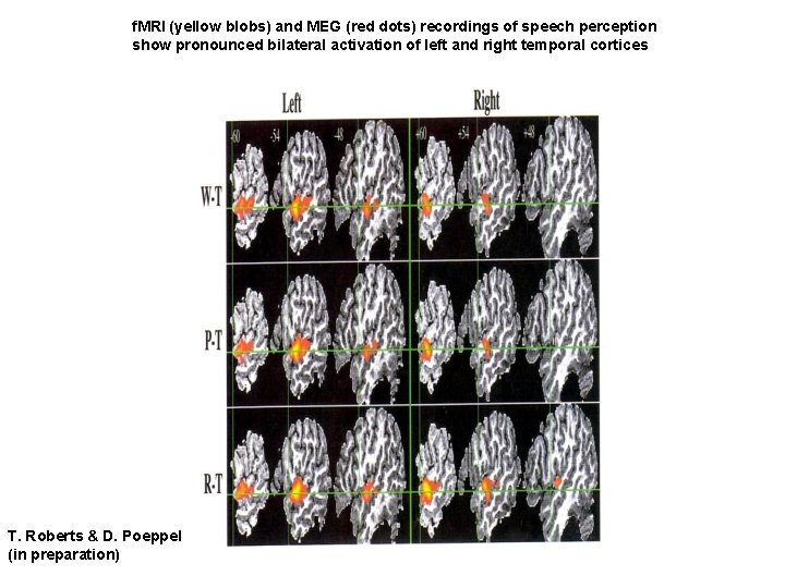 f. MRI (yellow blobs) and MEG (red dots) recordings of speech perception show pronounced