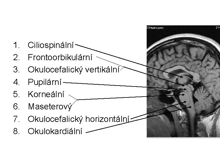 1. 2. 3. 4. 5. 6. 7. 8. Ciliospinální Frontoorbikulární Okulocefalický vertikální Pupilární Korneální