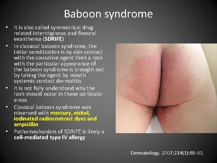 Baboon syndrome • It is also called symmetrical drug related intertriginous and flexural exanthema