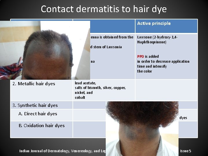 Contact dermatitis to hair dye Classification of hair dyes Source Active principle 1. Vegetable