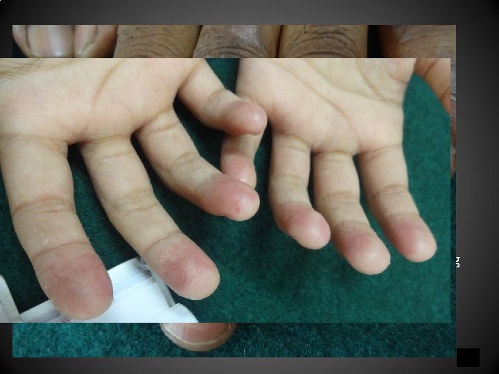 Irritant Contact Dermatitis Chronic Irritant Contact Dermatitis • Prolonged and repeated exposures of the