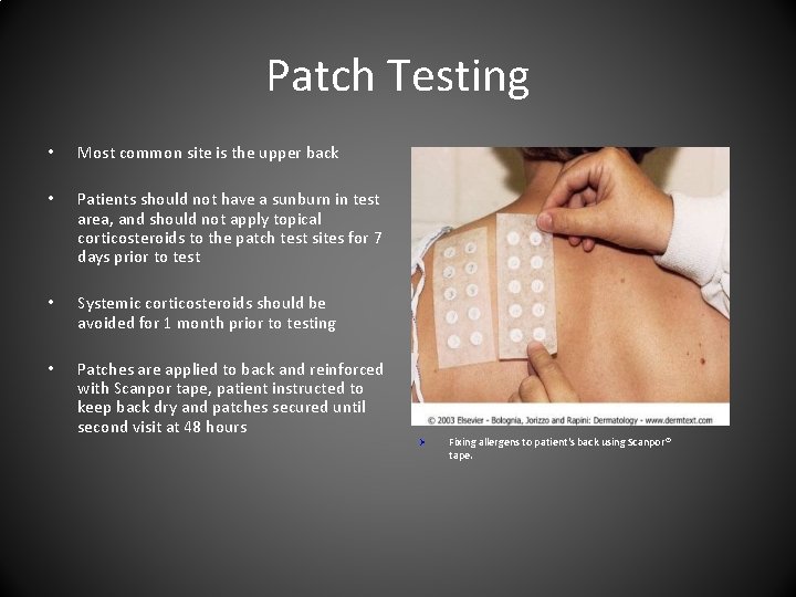 Patch Testing • Most common site is the upper back • Patients should not