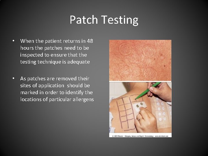 Patch Testing • When the patient returns in 48 hours the patches need to