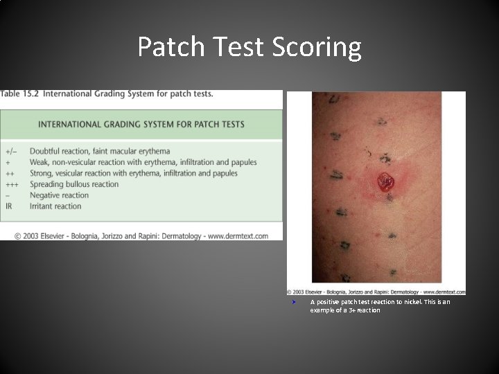 Patch Test Scoring Ø A positive patch test reaction to nickel. This is an