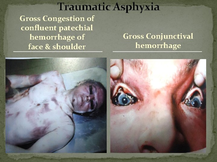 Traumatic Asphyxia Gross Congestion of confluent patechial hemorrhage of face & shoulder Gross Conjunctival