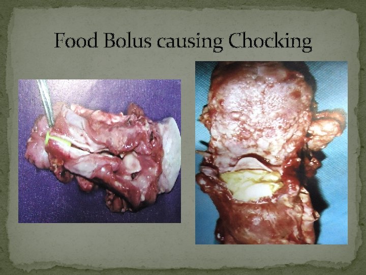 Food Bolus causing Chocking 