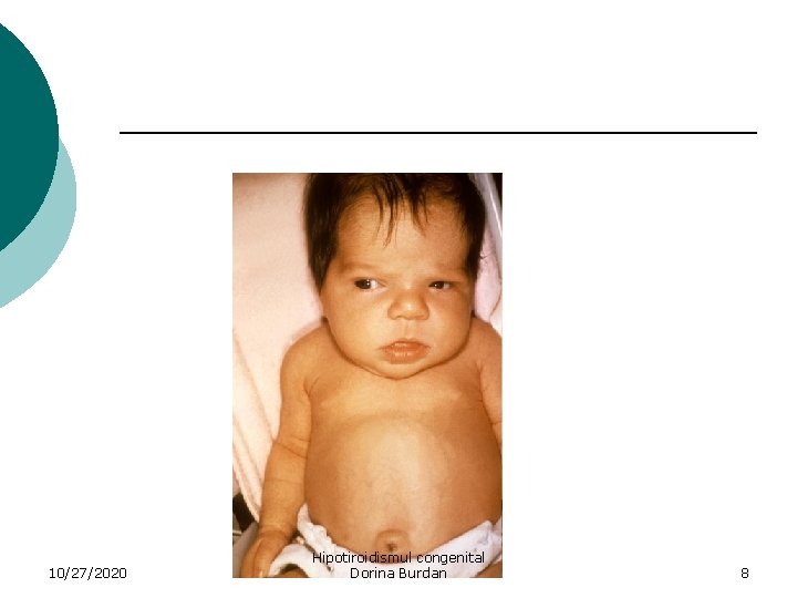 10/27/2020 Hipotiroidismul congenital Dorina Burdan 8 