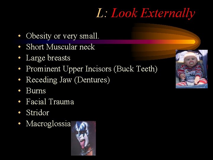 L: Look Externally • • • Obesity or very small. Short Muscular neck Large