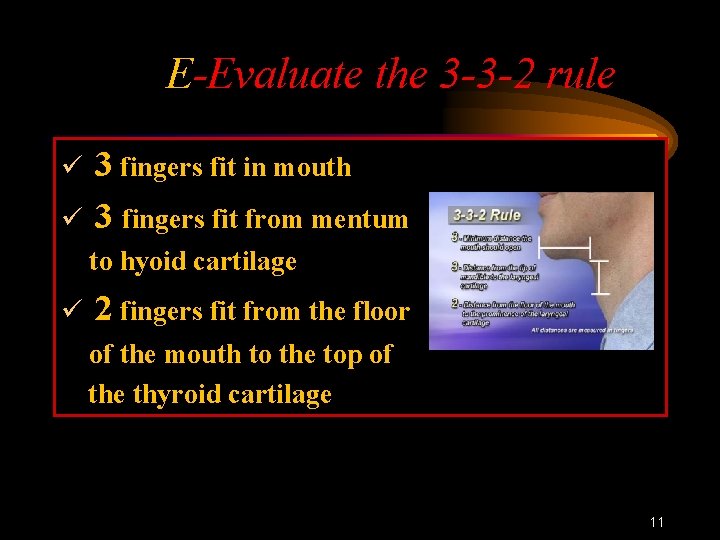 E-Evaluate the 3 -3 -2 rule ü ü 3 fingers fit in mouth 3