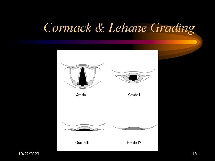 Cormack & Lehane Grading 10/27/2020 13 
