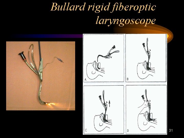 Bullard rigid fiberoptic laryngoscope 31 