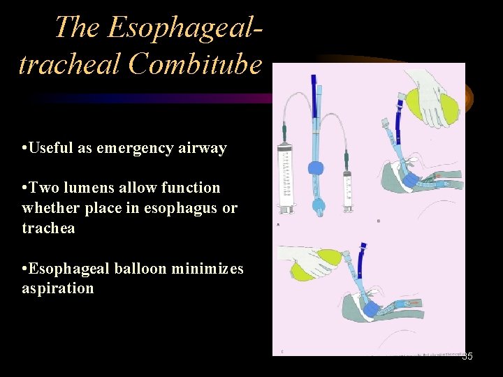 The Esophagealtracheal Combitube • Useful as emergency airway • Two lumens allow function whether