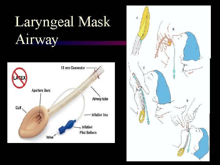 Laryngeal Mask Airway 