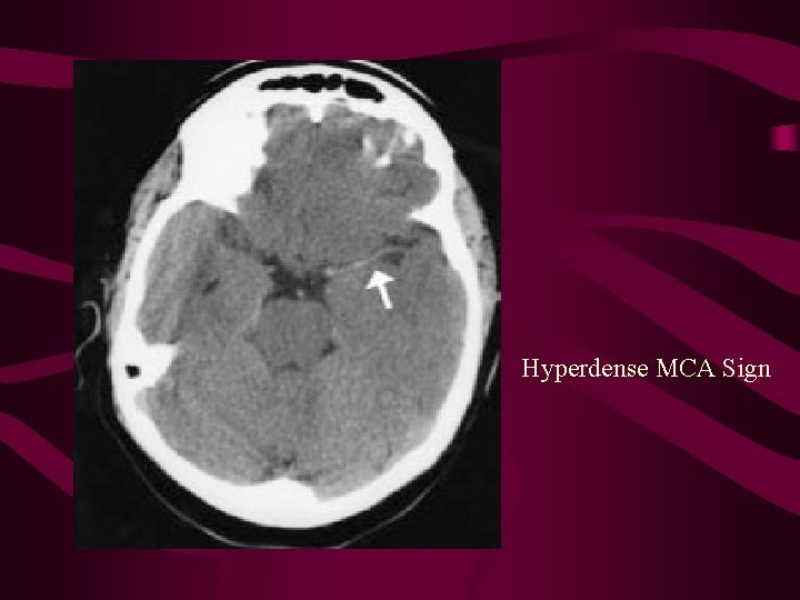 Hyperdense MCA Sign 