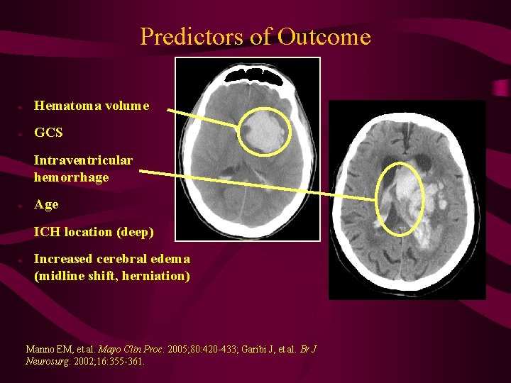 Predictors of Outcome ● Hematoma volume ● GCS ● Intraventricular hemorrhage ● Age ●