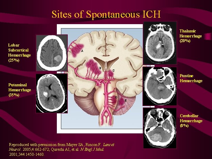 Sites of Spontaneous ICH Lobar Subcortical Hemorrhage (25%) Putaminal Hemorrhage (35%) Thalamic Hemorrhage (20%)