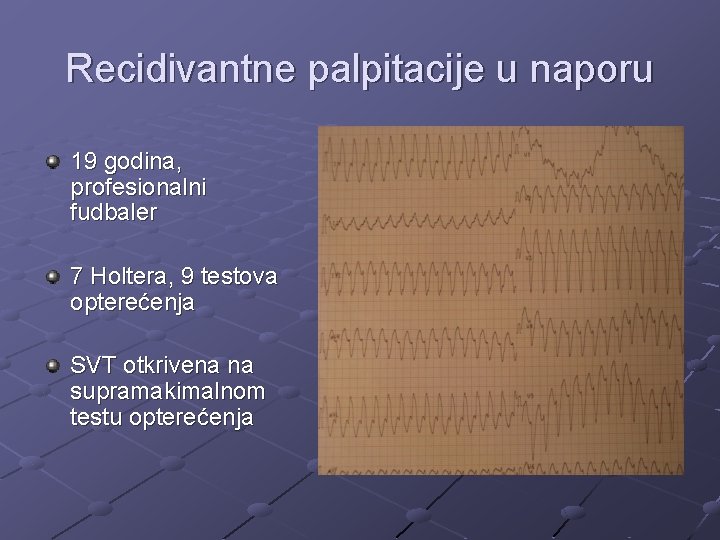 Recidivantne palpitacije u naporu 19 godina, profesionalni fudbaler 7 Holtera, 9 testova opterećenja SVT