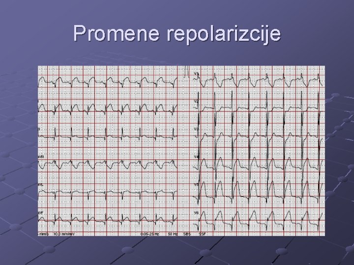 Promene repolarizcije 