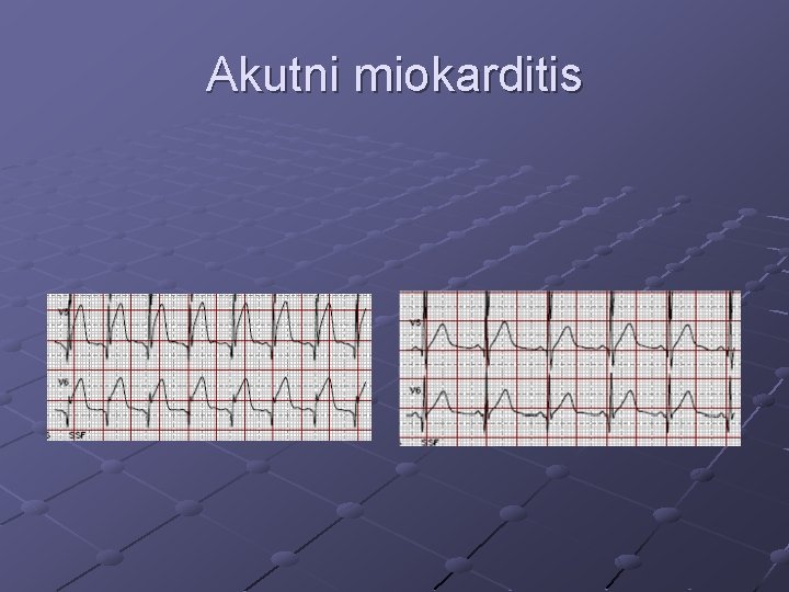 Akutni miokarditis 