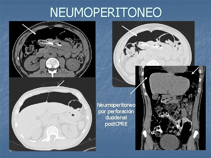NEUMOPERITONEO Neumoperitoneo por perforación duodenal post. CPRE 