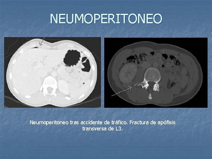 NEUMOPERITONEO Neumoperitoneo tras accidente de tráfico. Fractura de apófisis transversa de L 3. 