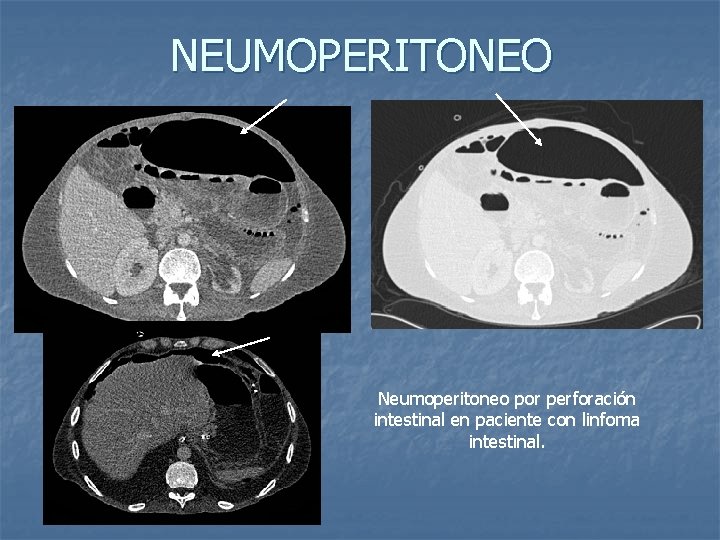 NEUMOPERITONEO Neumoperitoneo por perforación intestinal en paciente con linfoma intestinal. 