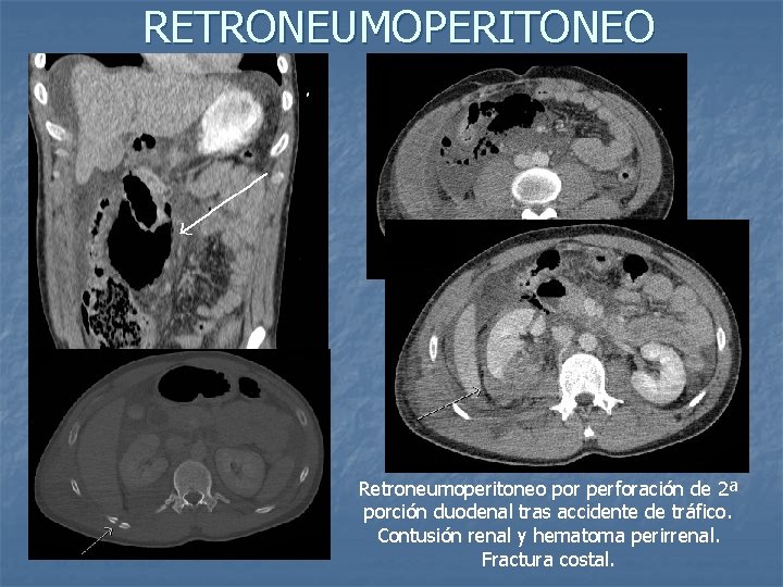 RETRONEUMOPERITONEO Retroneumoperitoneo por perforación de 2ª porción duodenal tras accidente de tráfico. Contusión renal
