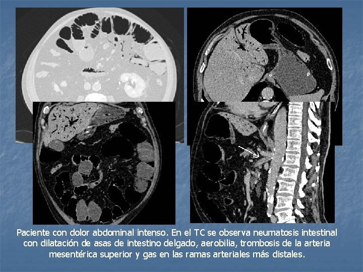 Paciente con dolor abdominal intenso. En el TC se observa neumatosis intestinal con dilatación