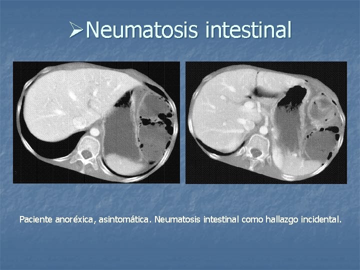 ØNeumatosis intestinal Paciente anoréxica, asintomática. Neumatosis intestinal como hallazgo incidental. 
