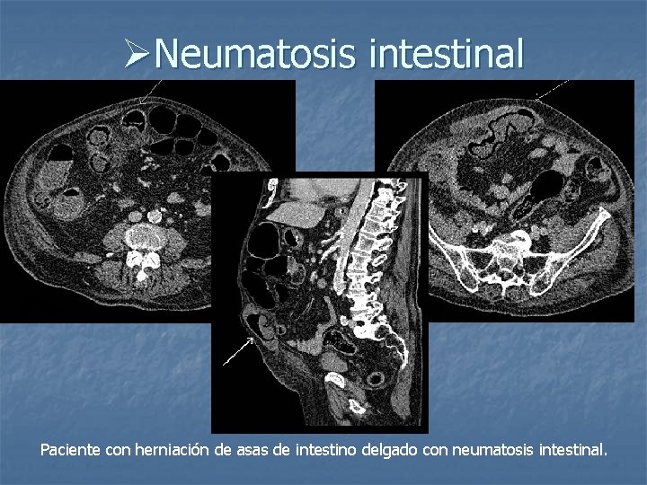 ØNeumatosis intestinal Paciente con herniación de asas de intestino delgado con neumatosis intestinal. 