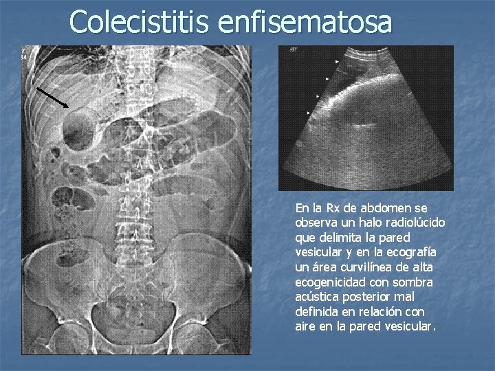 Colecistitis enfisematosa En la Rx de abdomen se observa un halo radiolúcido que delimita