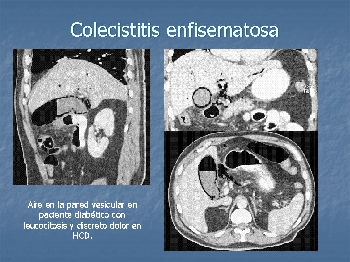 Colecistitis enfisematosa Aire en la pared vesicular en paciente diabético con leucocitosis y discreto