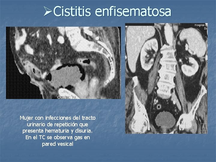 ØCistitis enfisematosa Mujer con infecciones del tracto urinario de repetición que presenta hematuria y