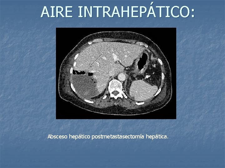 AIRE INTRAHEPÁTICO: Absceso hepático postmetastasectomía hepática. 