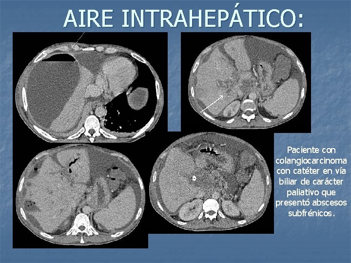AIRE INTRAHEPÁTICO: Paciente con colangiocarcinoma con catéter en vía biliar de carácter paliativo que
