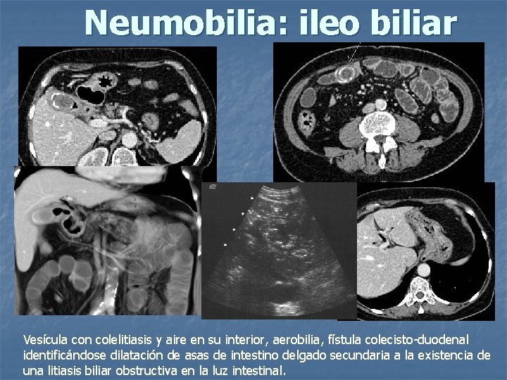 Neumobilia: ileo biliar Vesícula con colelitiasis y aire en su interior, aerobilia, fístula colecisto-duodenal