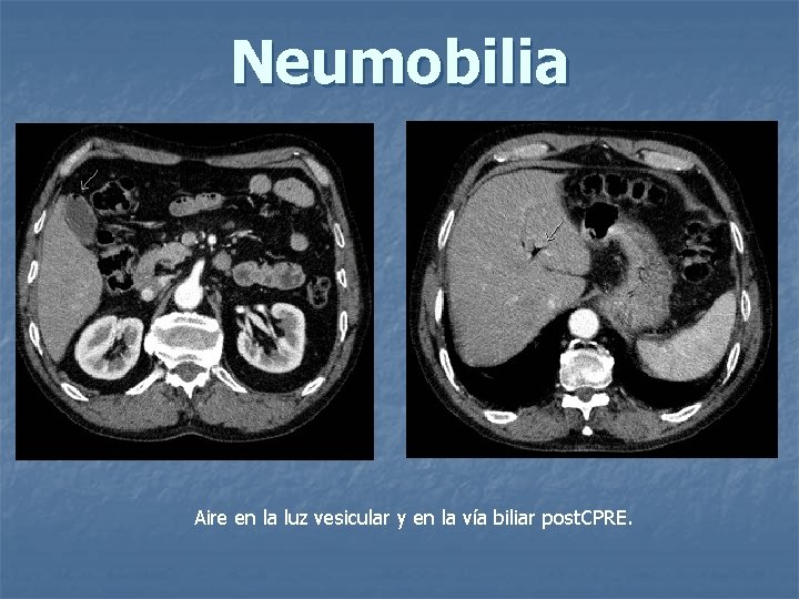 Neumobilia Aire en la luz vesicular y en la vía biliar post. CPRE. 