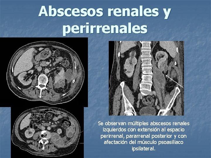 Abscesos renales y perirrenales Se observan múltiples abscesos renales izquierdos con extensión al espacio