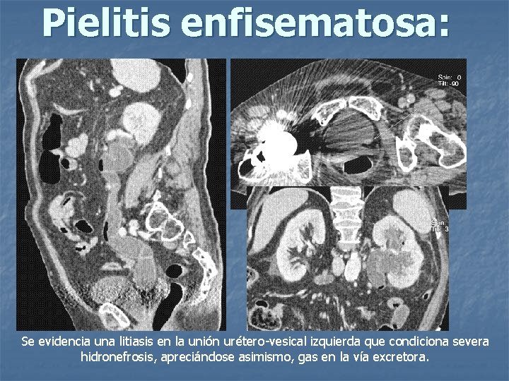Pielitis enfisematosa: Se evidencia una litiasis en la unión urétero-vesical izquierda que condiciona severa
