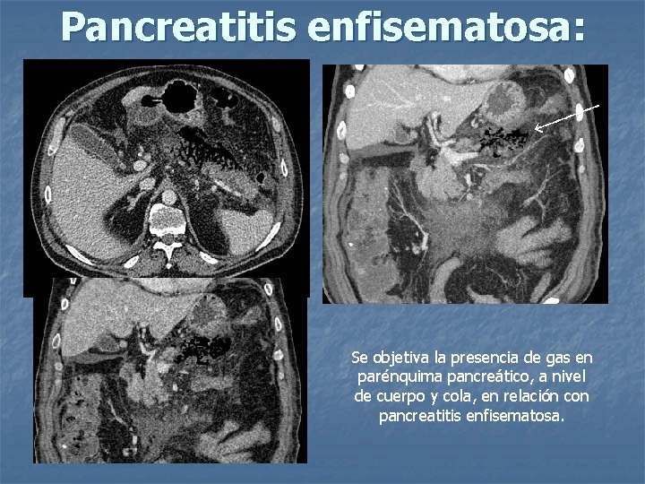 Pancreatitis enfisematosa: Se objetiva la presencia de gas en parénquima pancreático, a nivel de