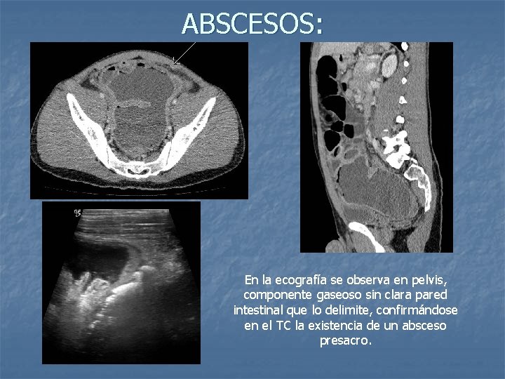 ABSCESOS: En la ecografía se observa en pelvis, componente gaseoso sin clara pared intestinal