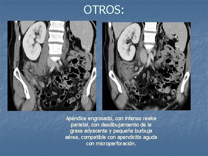 OTROS: Apéndice engrosado, con intenso realce parietal, con desdibujamiento de la grasa adyacente y