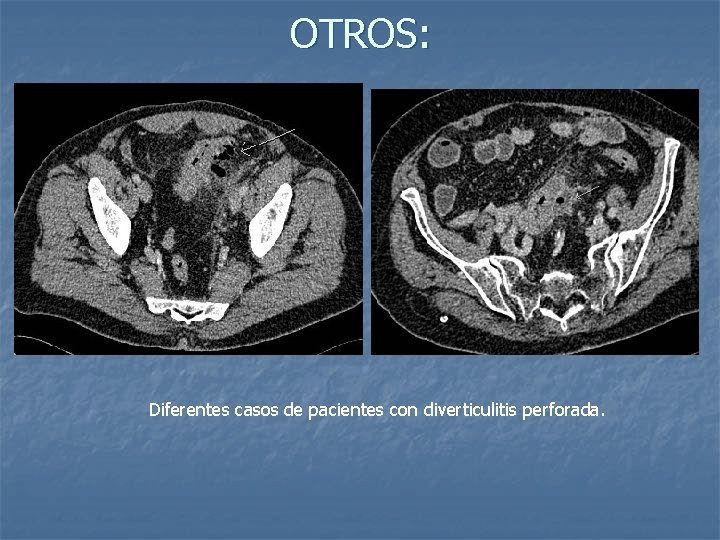 OTROS: Diferentes casos de pacientes con diverticulitis perforada. 