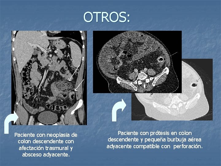OTROS: Paciente con neoplasia de colon descendente con afectación trasmural y absceso adyacente. Paciente