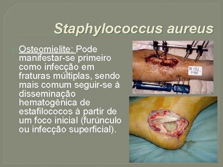 Staphylococcus aureus � Osteomielite: Pode manifestar-se primeiro como infecção em fraturas múltiplas, sendo mais