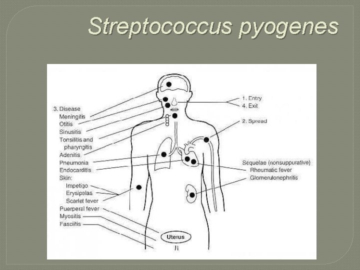 Streptococcus pyogenes 