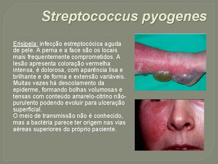 Streptococcus pyogenes Erisipela: infecção estreptocócica aguda de pele. A perna e a face são
