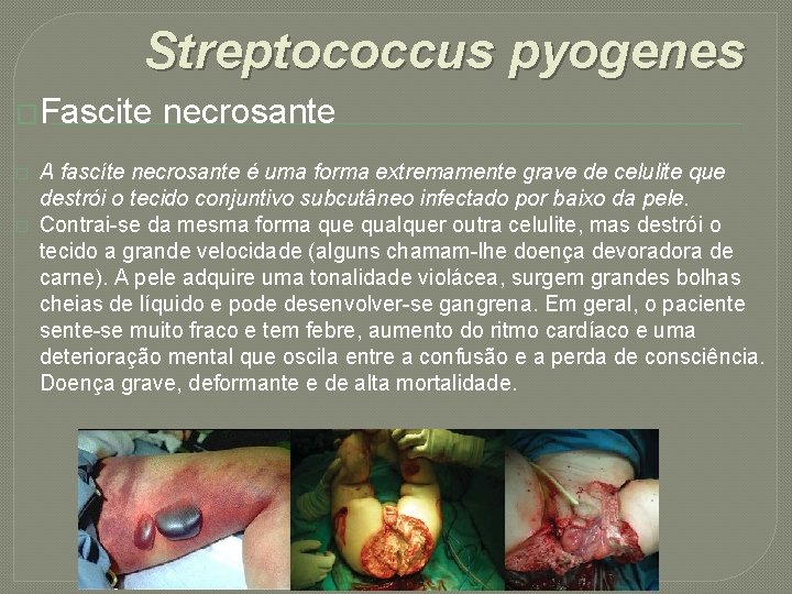 Streptococcus pyogenes �Fascite necrosante � � A fascíte necrosante é uma forma extremamente grave